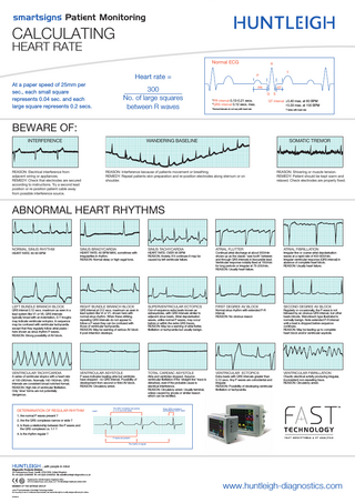 smartsigns Patient Monitoring  CALCULATING HEART RATE  Normal ECG  Heart rate = At a paper speed of 25mm per sec., each small square represents 0.04 sec. and each large square represents 0.2 secs.  300 No. of large squares between R waves  R T  P  PR  ST Q  *PR interval 0.13-0.21 secs. *QRS interval 0.12 secs. max.  S  QT interval † 0.40 max. at 60 BPM † 0.33 max. at 100 BPM  *Normal intervals do not vary with heart rate  † Varies with heart rate  BEWARE OF: INTERFERENCE  WANDERING BASELINE  REASON: Electrical interference from adjacent wiring or appliances. REMEDY: Check that electrodes are secured according to instructions. Try a second lead position or re-position patient cable away from possible interference source.  SOMATIC TREMOR  REASON: Interference because of patients movement or breathing. REMEDY: Repeat patients skin preparation and re-position electrodes along sternum or on shoulder.  REASON: Shivering or muscle tension. REMEDY: Patient should be kept warm and relaxed. Check electrodes are properly fixed.  ABNORMAL HEART RHYTHMS  NORMAL SINUS RHYTHM  SINUS BRADYCARDIA  SINUS TACHYCARDIA  ATRIAL FLUTTER  ATRIAL FIBRILLATION  LEFT BUNDLE BRANCH BLOCK  RIGHT BUNDLE BRANCH BLOCK  SUPERVENTRICULAR ECTOPICS  FIRST DEGREE AV BLOCK  SECOND DEGREE AV BLOCK  VENTRICULAR TACHYCARDIA  VENTRICULAR ASYSTOLE  TOTAL CARDIAC ASYSTOLE  VENTRICULAR ECTOPICS  VENTRICULAR FIBRILLATION  HEART RATE: 60-90 BPM  QRS interval 0.12 secs. maximum as seen in a lead system like V1 or V6. QRS intervals typically broad with an indentation, S-T troughs may indicate ventricular ectopics. In sequence may be confused with ventricular tachycardia except that they regularly follow atrial peaks here shown as sinus rhythm P waves. REASON: Strong possibility of AV block.  A series of ventricular etopics with a heart rate of 100-280/min. Normally 140-180/min. QRS intervals are consistent broad notched format. REASON: High risk of ventricular fibrillation. Only ‘slow’ forms are not potentially dangerous.  HEART RATE: 60 BPM MAX, sometimes with irregularities in rhythm. REASON: Normal sleep or high vagal tone.  QRS interval at 012 secs. maximum as seen in lead system like Vr or V1, shown here with normal sinus rhythm. When these striking, repeating QRS intervals do not appear to follow a P wave they can be confused with those of ventricular tachycardia. REASON: May be warning of serious AV block if post-infarction develops.  P wave indicates beating atria but ventricles have stopped - no QRS interval. Possibility of development from second or third AV block. REASON: Circulatory arrest.  DETERMINATION OF REGULAR RHYTHM  Lead I  The QRS complexes are narrow (< 0.12 seconds wide)  HEART RATE: OVER 90 BPM REASON: Anxiety. If it continues it may be caused by left ventricular failure.  Out-of-sequence extra beats known as extrasystoles, with QRS intervals similar to adjacent sinus beats. Atrial depolarisation waves, unlike normal P waves, may occur before or within the extra QRS traces. REASON: May be a warning of atrial flutter, fibrillation or tachycardia but usually benign.  Atria and ventricles stopped. Assume ventricular fibrillation if the ‘straight line’ trace is disturbed, even if the probable cause is electrical interference. REASON: Circulatory arrest. Usually terminal, unless caused by anoxia or similar reason which can be rectified.  Continual atrial discharge at about 300/min shows up as the classic ‘saw tooth’ between and through QRS intervals in favourable lead. Ventricular response notably fixed at 150/min for long periods or irregular at 75-200/min. REASON: Usually heart failure.  Normal sinus rhythm with extended P-R interval. REASON: No obvious reason  Extra beats with QRS intervals greater than 0.12 secs. Any P waves are coincidental and irregular. REASON: Possibility of developing ventricular fibrillation or tachycardia.  Irregular fine or coarse atrial depolarisation waves at a rapid rate of 400-600/min. Irregular ventricular response (QRS interval) in absence of complete heart block. REASON: Usually heart failure.  Regularly or occasionally, the P wave is not followed by an obvious QRS interval, but other beats intrude. Wenckbach type illustrated is normally benign. Note extended P-R interval until a beat is dropped before sequence continues. REASON: May be leading up to complete heart block and/or ventricular asystole.  Chaotic electrical activity producing irregular, inconsistent non-repeating trace. REASON: Circulatory arrest.  Every QRS complex is preceeded by one P wave  1. Are normal P waves present ? 2. Are the QRS complexes narrow or wide ? 3. Is there a relationship between the P waves and the QRS complexes i.e. 1:1 ? 4. Is the rhythm regular ? P waves are present The rhythm is regular  …with people in mind Diagnostic Products Division 35 Portmanmoor Road, Cardiff, CF24 5HN, United Kingdom T: +44 (0)29 20485885 F: +44 (0)29 20492520 E: sales@huntleigh-diagnostics.co.uk Registered No: 942245 England. Registered Office: 310-312 Dallow Road, Luton, Beds, LU1 1TD ©Huntleigh Healthcare Limited 2008  MEMBER OF THE GETINGE GROUP ® and ™ are trademarks of Huntleigh Technology Limited As our policy is one of continuous improvement, we reserve the right to modify designs without prior notice.  747469-A  www.huntleigh-diagnostics.com  