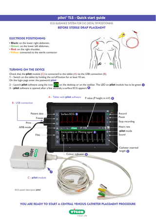 pilot® TLS - Quick start guide ECG GUIDANCE SYSTEM FOR CVC DISTAL TIP POSITIONING  BEFORE STERILE DRAP PLACEMENT ELECTRODE POSITIONING • Black: on the lower right abdomen, • Green: on the lower left abdomen, • Red: on the right shoulder, • Yellow: connected to the sterile connector  TURNING ON THE DEVICE Check that the pilot module (C) is connected to the tablet (A) via the USB connection (B). 1 – Switch on the tablet by holding the on/off button for at least 10 sec. On the login page enter the password: pilot 2 – Launch pilot software using the icon on the desktop or on the taskbar. The LED on pilot module has to be green 1 . 3 – pilot software is opened, after a few seconds, a surface ECG appears 2 . A - Tablet with pilot software  P value (P height in mV) 5  B - USB connection  Patient data  Surface ECG 2  Freeze  Record Pause Stop recording  Print  Heart rate  AFIB mode Intracavitary or Piloting signal 3  Files  pilot mode Sound  Catheter inserted length 6 Colour indicator 4  1  C - pilot module  ECG system description pilot  YOU ARE READY TO START A CENTRAL VENOUS CATHETER PLACEMENT PROCEDURE  
