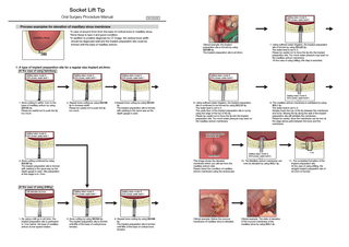 Socket Lift Tip Oral Surgery Procedure Manual May 2013
