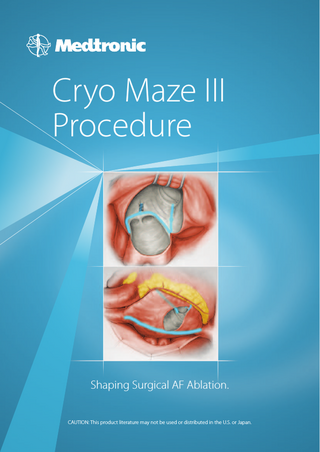 Cryo Maze III Procedure  Shaping Surgical AF Ablation. CAUTION: This product literature may not be used or distributed in the U.S. or Japan.  
